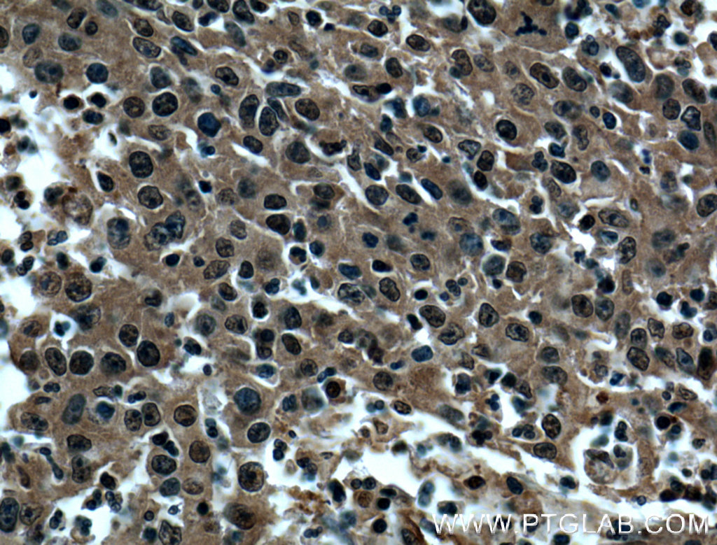 Immunohistochemistry (IHC) staining of human colon cancer tissue using SUMO2/3 Polyclonal antibody (10947-1-AP)