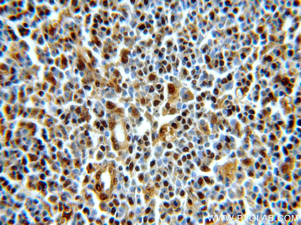 Immunohistochemistry (IHC) staining of human spleen tissue using SUPT16H Polyclonal antibody (20551-1-AP)