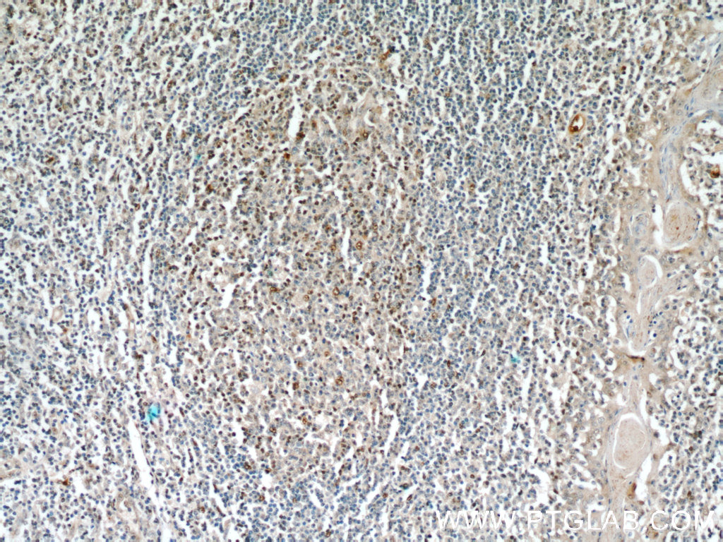 Immunohistochemistry (IHC) staining of human tonsillitis tissue using SUPT16H Polyclonal antibody (20551-1-AP)