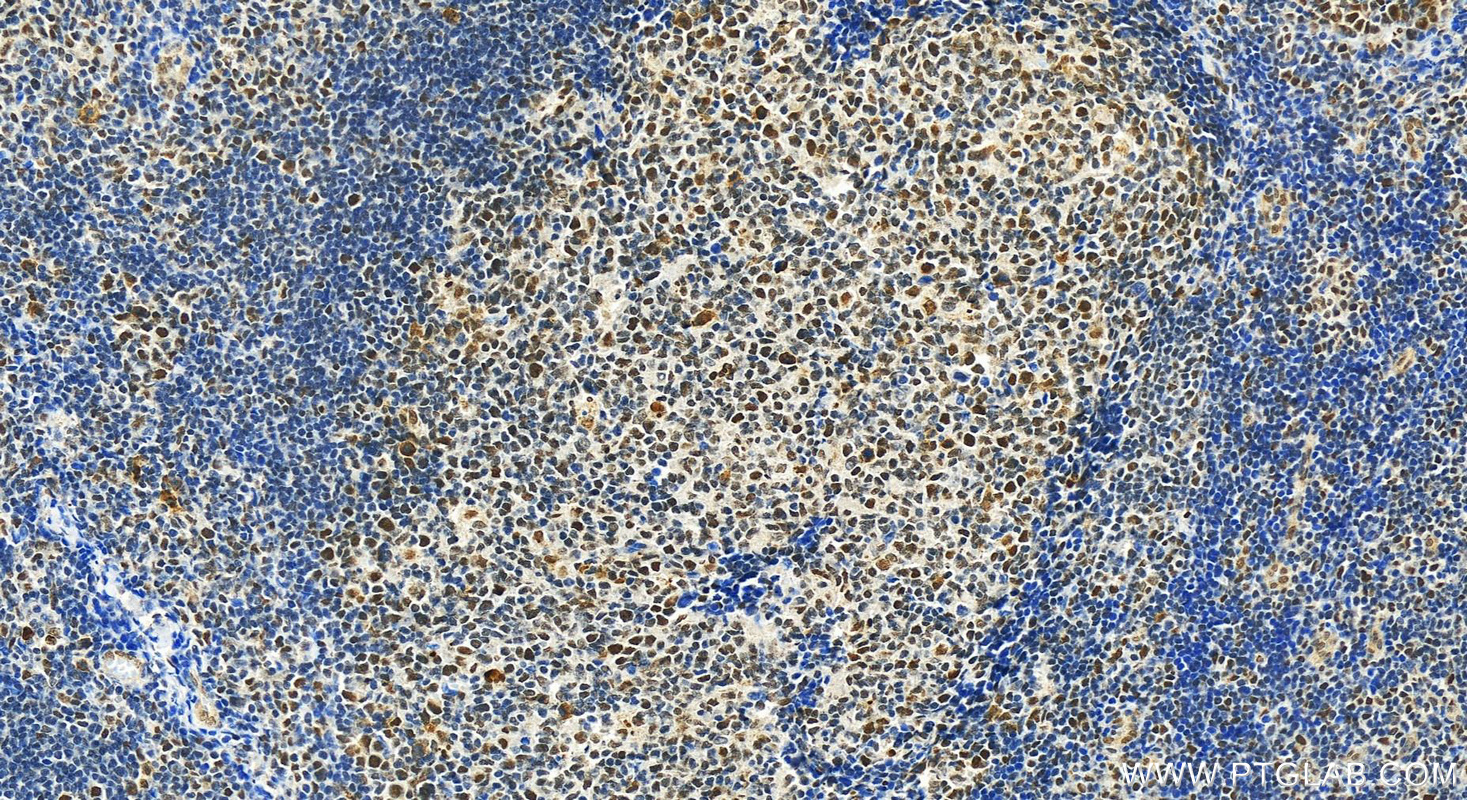 Immunohistochemistry (IHC) staining of human tonsillitis tissue using SUPT16H Polyclonal antibody (28598-1-AP)