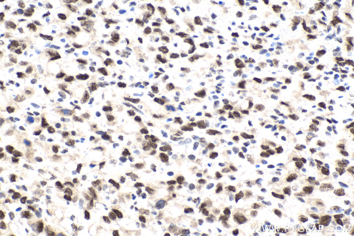 Immunohistochemistry (IHC) staining of human stomach cancer tissue using SUPT6H Polyclonal antibody (23073-1-AP)