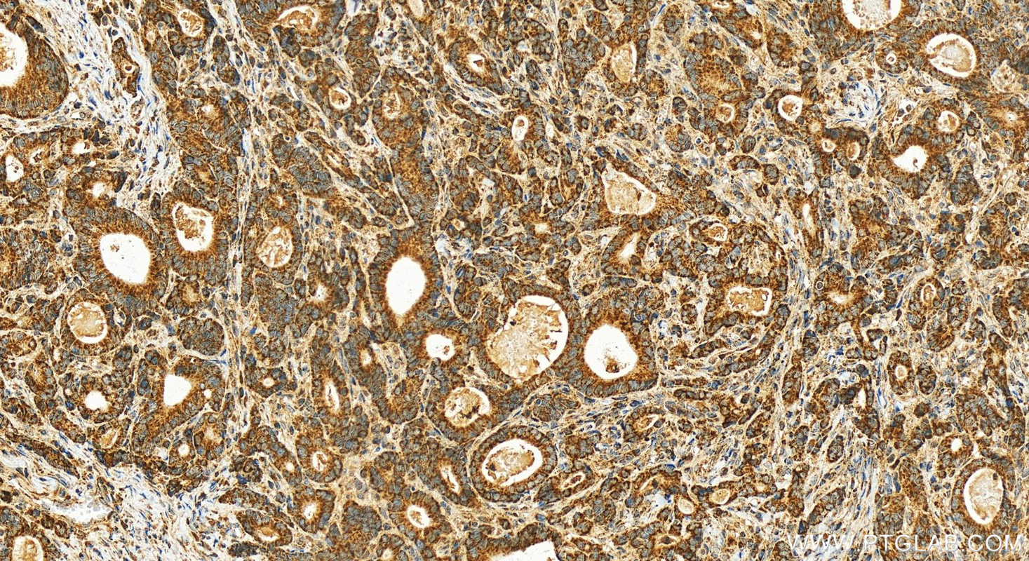 Immunohistochemistry (IHC) staining of human stomach cancer tissue using SUPV3L1 Polyclonal antibody (12826-1-AP)