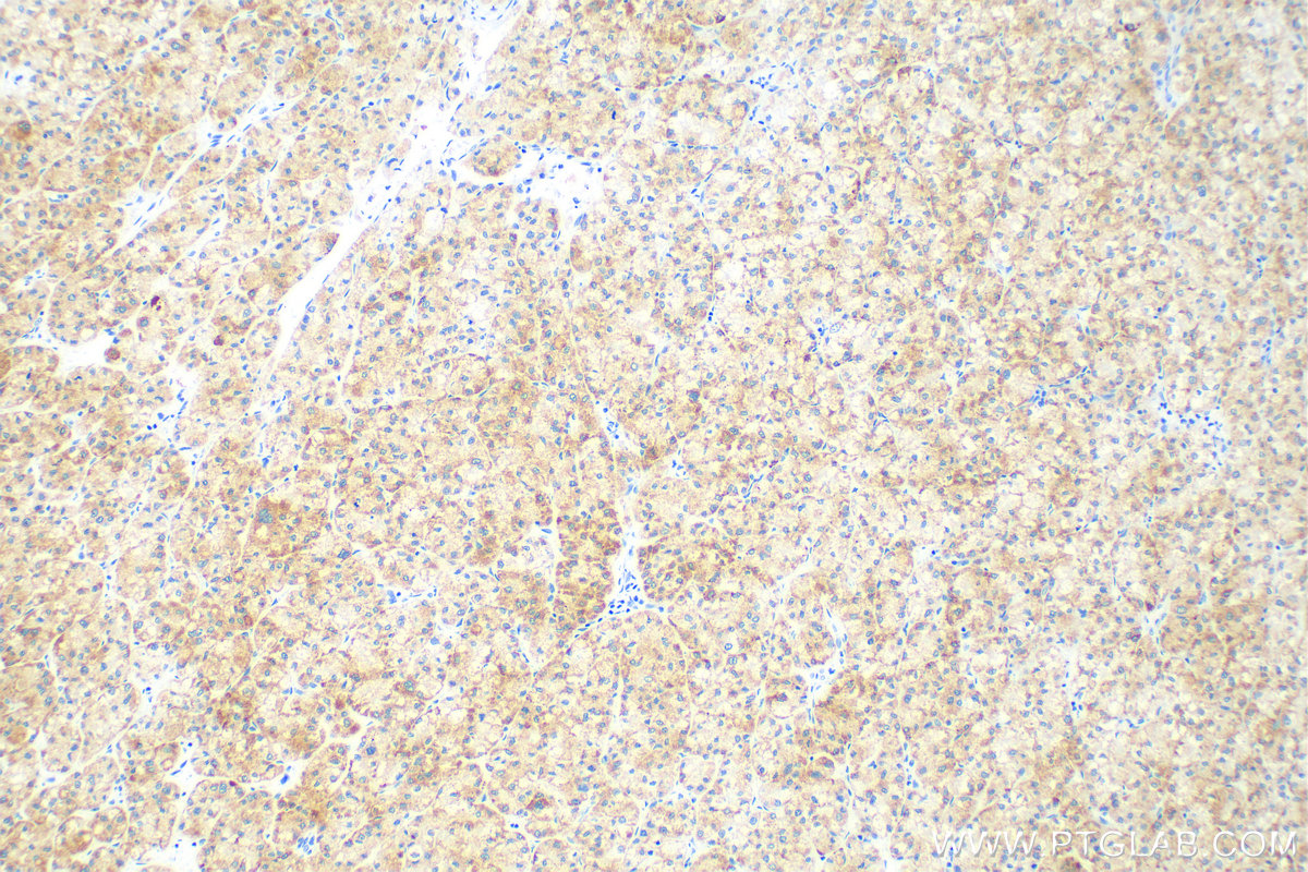 Immunohistochemistry (IHC) staining of human liver cancer tissue using SURF1 Recombinant antibody (83052-7-RR)