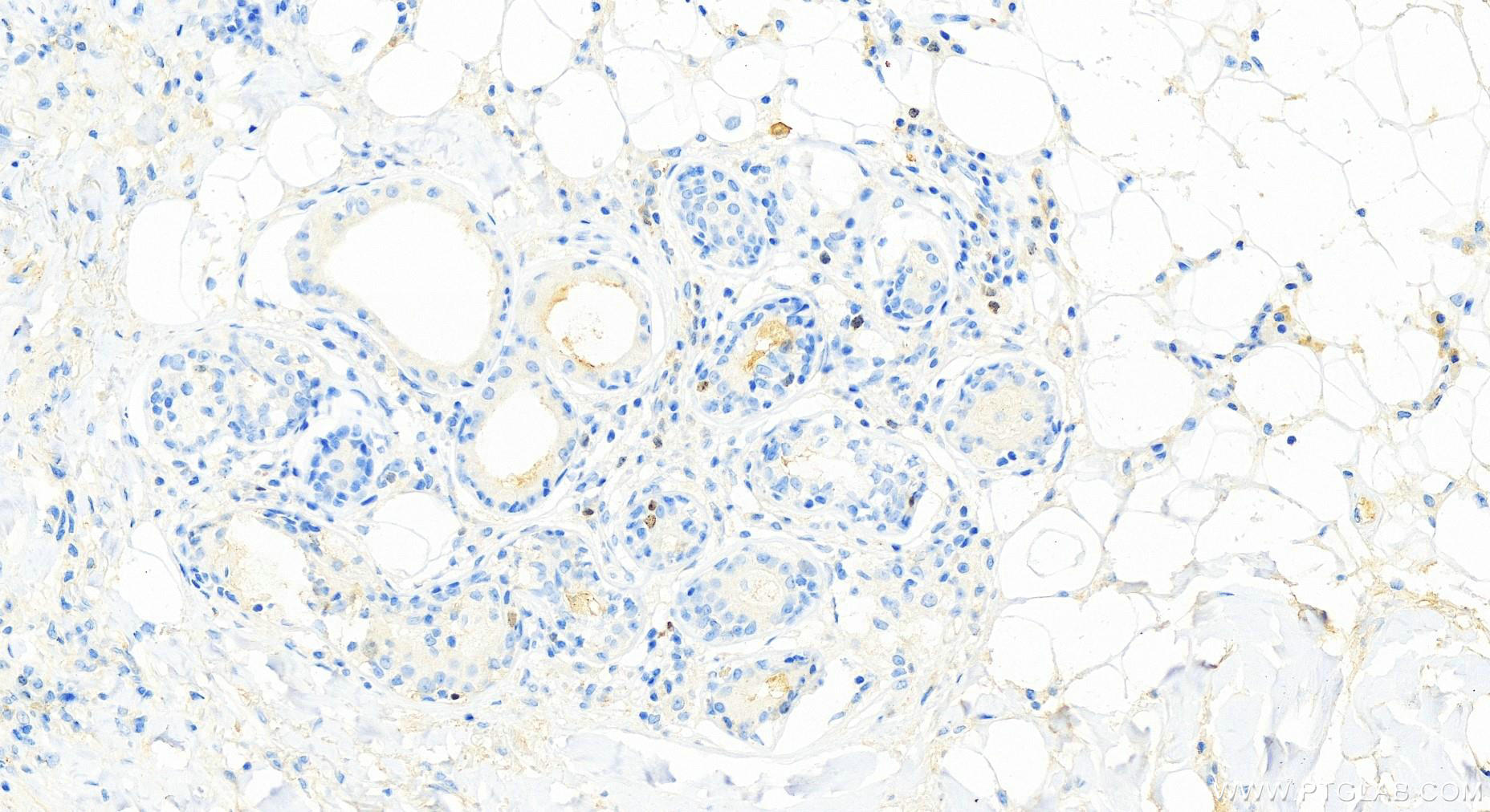 Immunohistochemistry (IHC) staining of human skin cancer tissue using SURVIVIN Monoclonal antibody (66495-1-Ig)