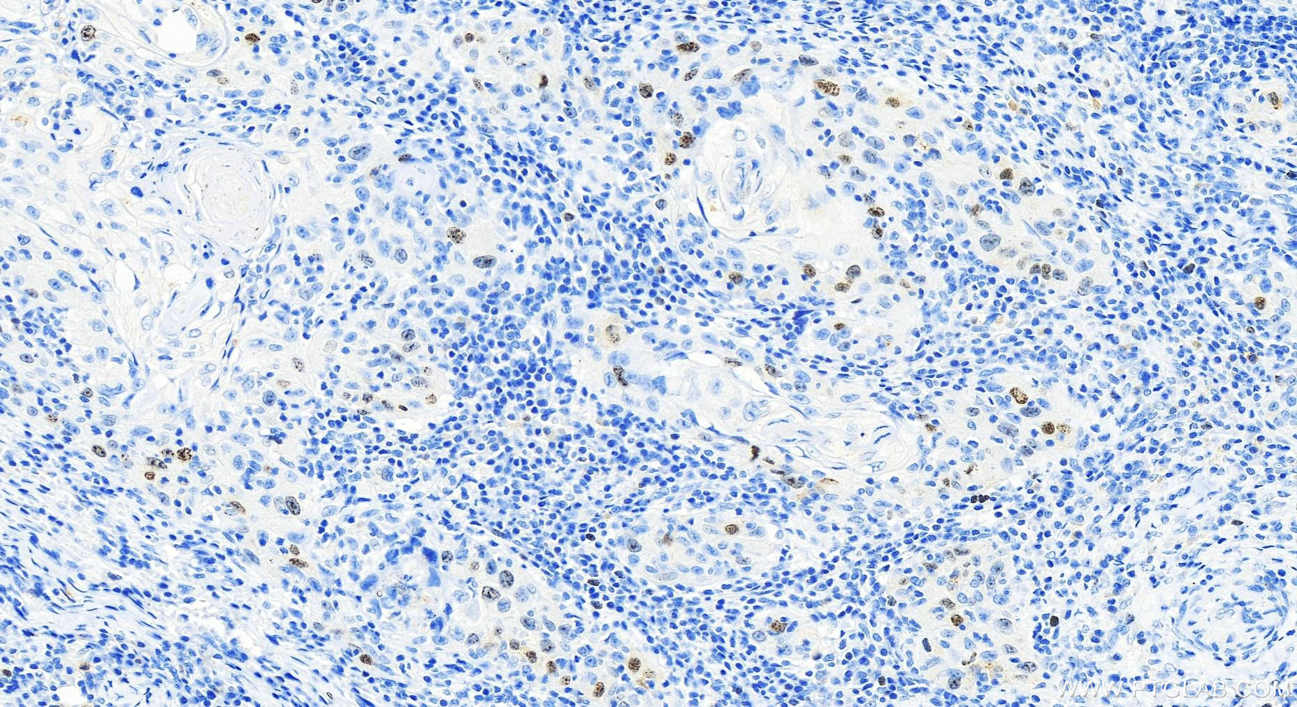 Immunohistochemistry (IHC) staining of human skin cancer tissue using SURVIVIN Monoclonal antibody (66495-1-Ig)