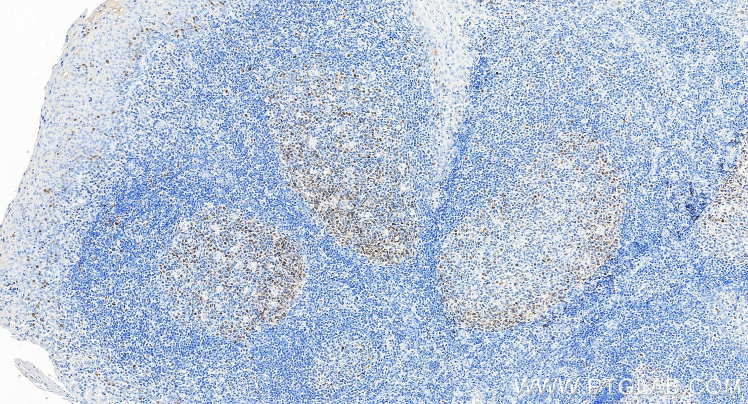 Immunohistochemistry (IHC) staining of human tonsillitis tissue using SURVIVIN Monoclonal antibody (66495-1-Ig)