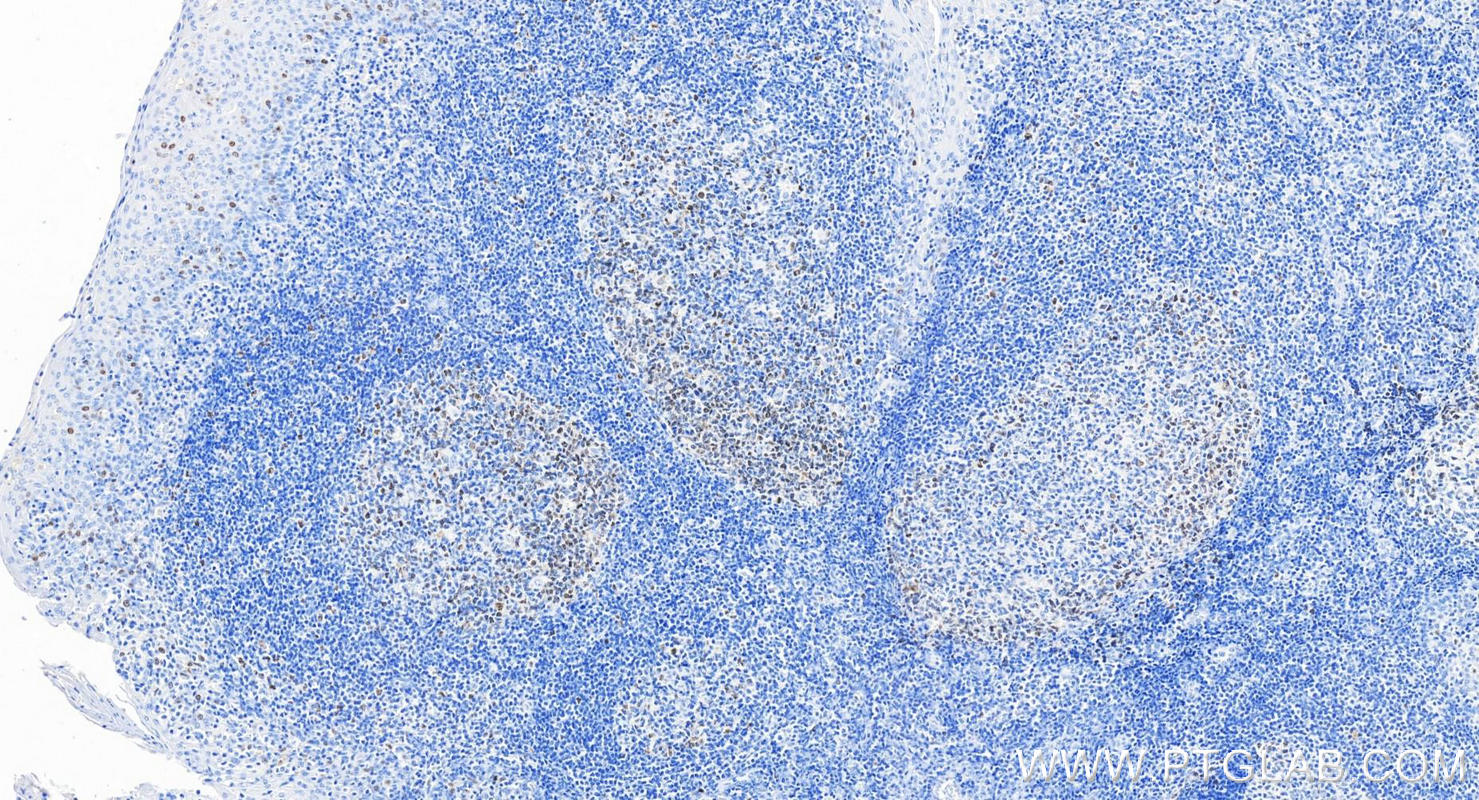 Immunohistochemistry (IHC) staining of human tonsillitis tissue using SURVIVIN Monoclonal antibody (66495-1-Ig)