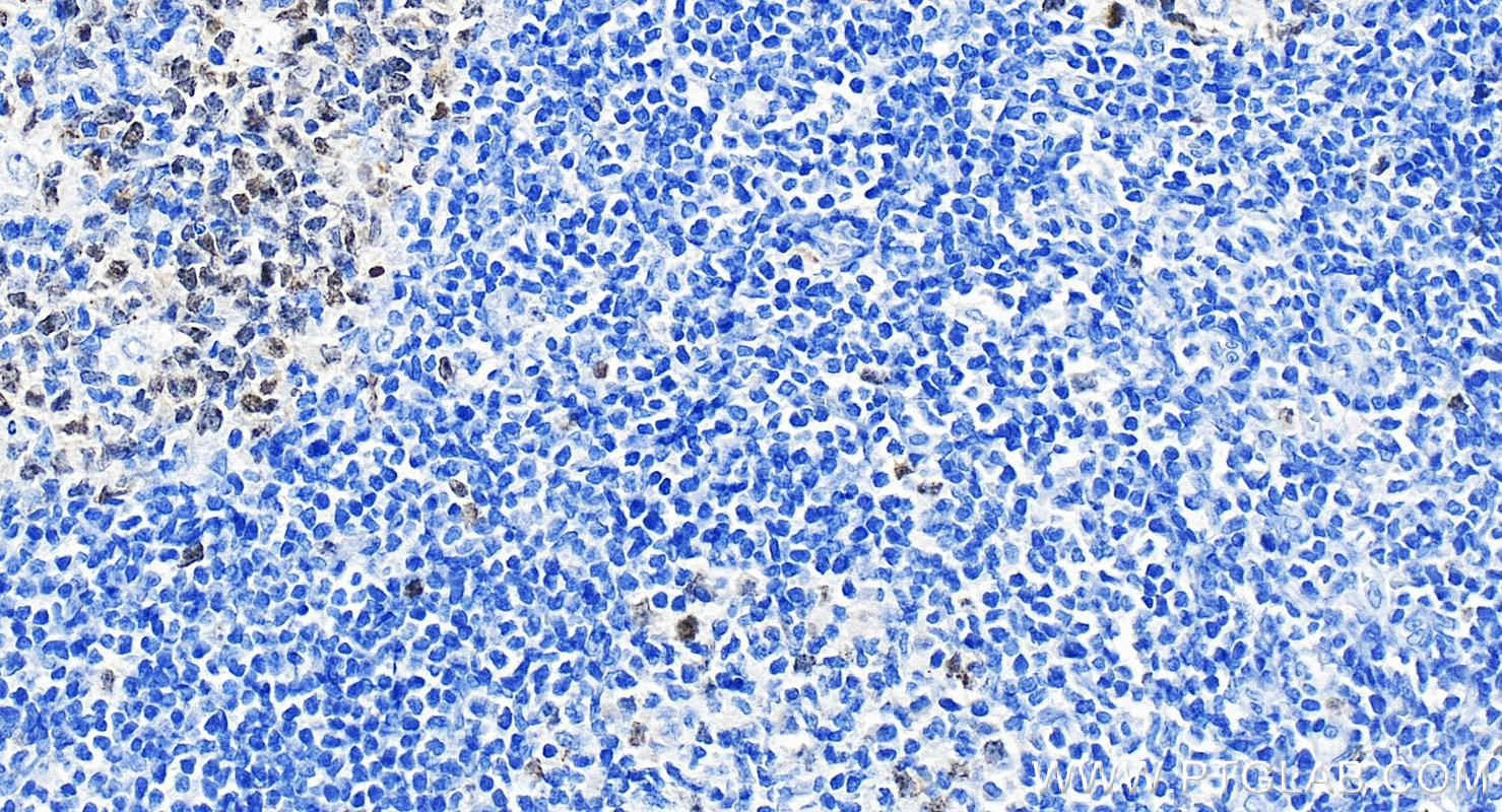 Immunohistochemistry (IHC) staining of human tonsillitis tissue using SURVIVIN Monoclonal antibody (66495-1-Ig)