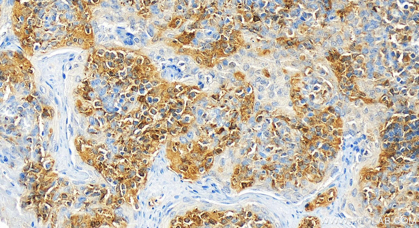 Immunohistochemistry (IHC) staining of human tonsillitis tissue using SYK Monoclonal antibody (66721-1-Ig)