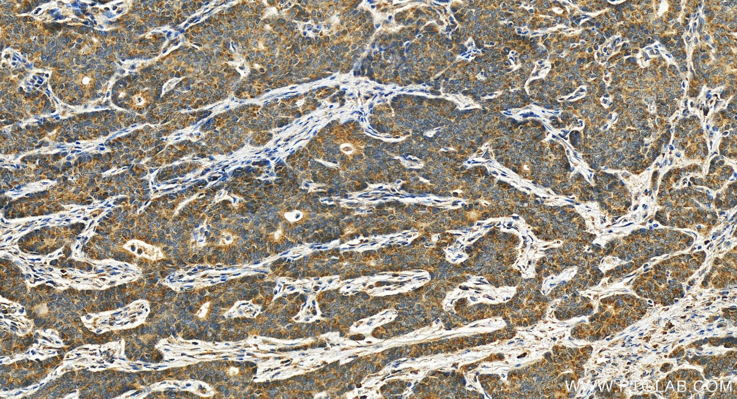 Immunohistochemistry (IHC) staining of human stomach cancer tissue using Synaptotagmin-13 Polyclonal antibody (18115-1-AP)