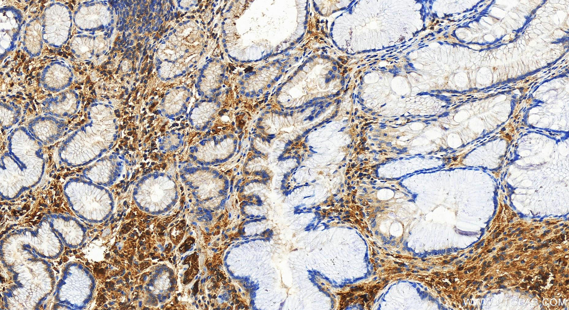 Immunohistochemistry (IHC) staining of human stomach cancer tissue using Serum amyloid P component Polyclonal antibody (31813-1-AP)