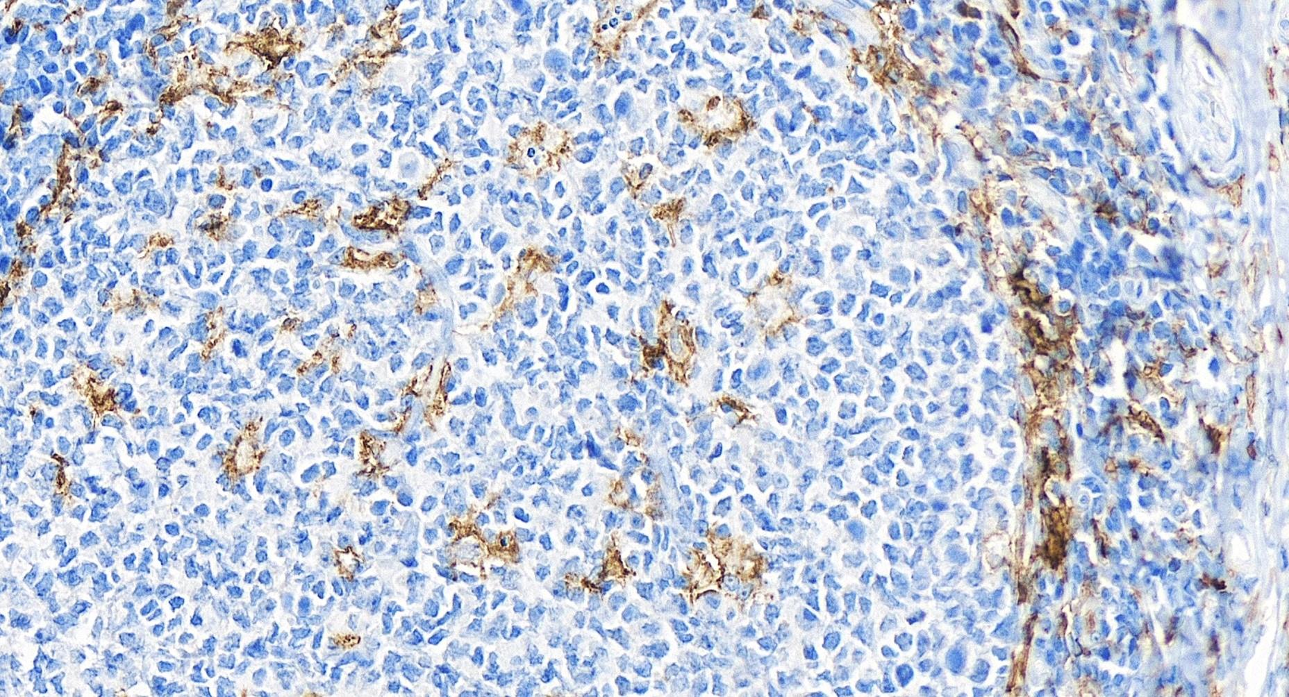 Immunohistochemistry (IHC) staining of human tonsillitis tissue using Siglec-7/CD328 Recombinant antibody (84253-4-RR)