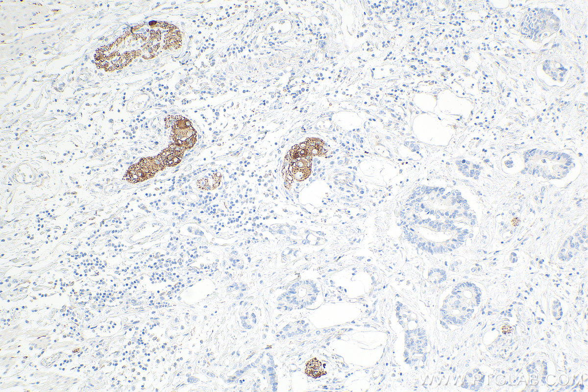 Immunohistochemistry (IHC) staining of human rectal cancer tissue using Synaptophysin Monoclonal antibody (67864-1-Ig)