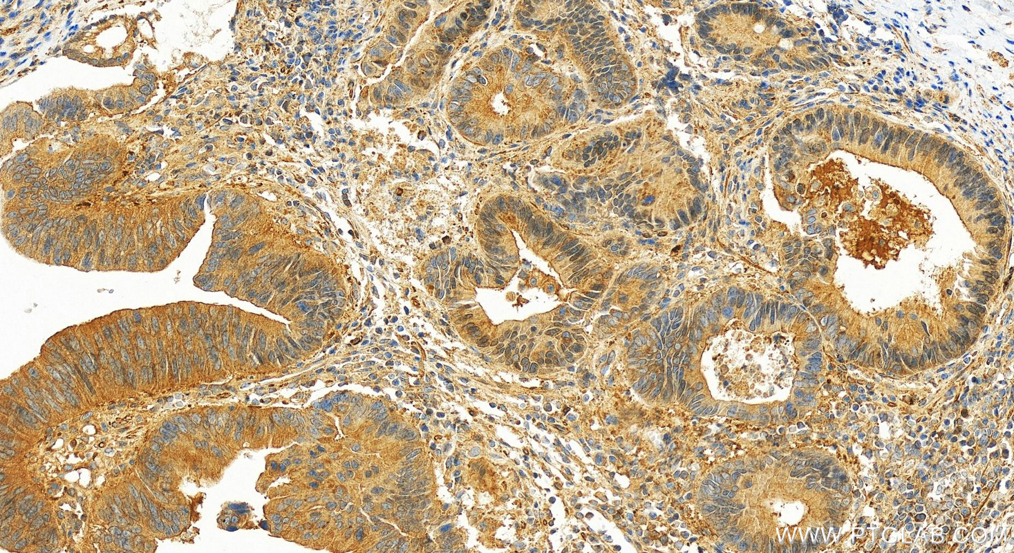 Immunohistochemistry (IHC) staining of human colon cancer tissue using TAB1 Polyclonal antibody (27566-1-AP)