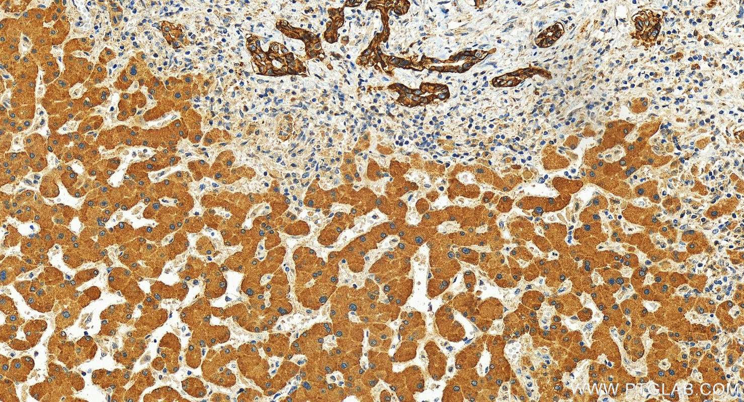 Immunohistochemistry (IHC) staining of human intrahepatic cholangiocarcinoma tissue using TACSTD2/TROP2 Polyclonal antibody (29856-1-AP)