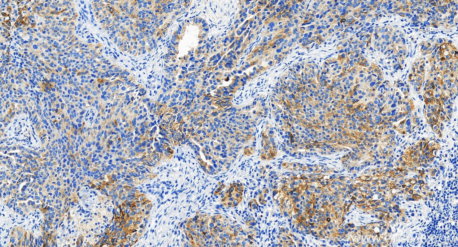 Immunohistochemistry (IHC) staining of human ovary cancer tissue using TACSTD2/TROP2 Polyclonal antibody (29856-1-AP)