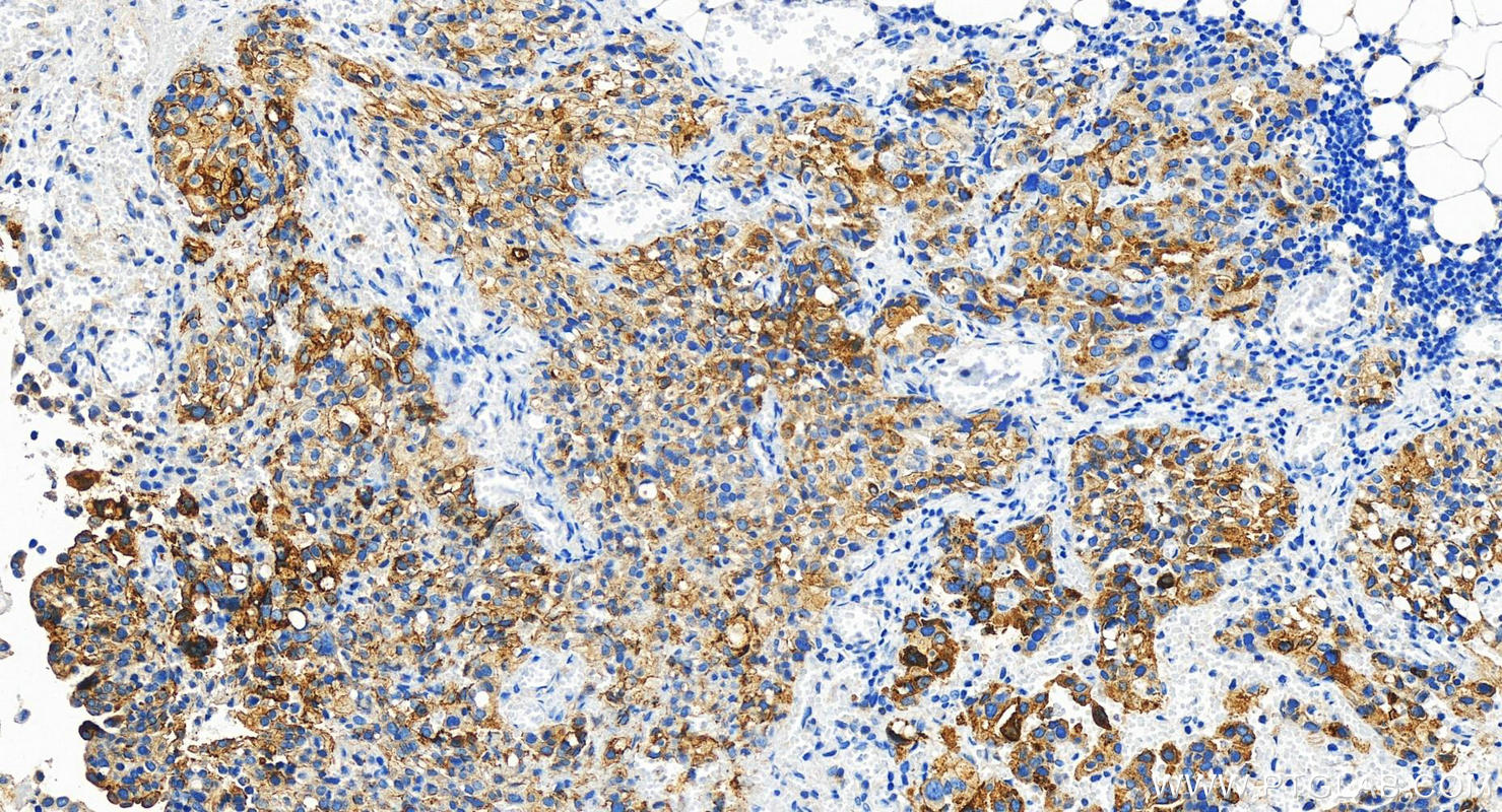 Immunohistochemistry (IHC) staining of human ovary cancer tissue using TACSTD2/TROP2 Polyclonal antibody (29856-1-AP)