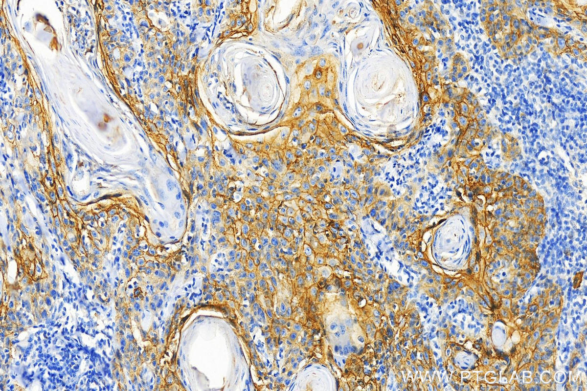 Immunohistochemistry (IHC) staining of human skin cancer tissue using TACSTD2/TROP2 Polyclonal antibody (29856-1-AP)