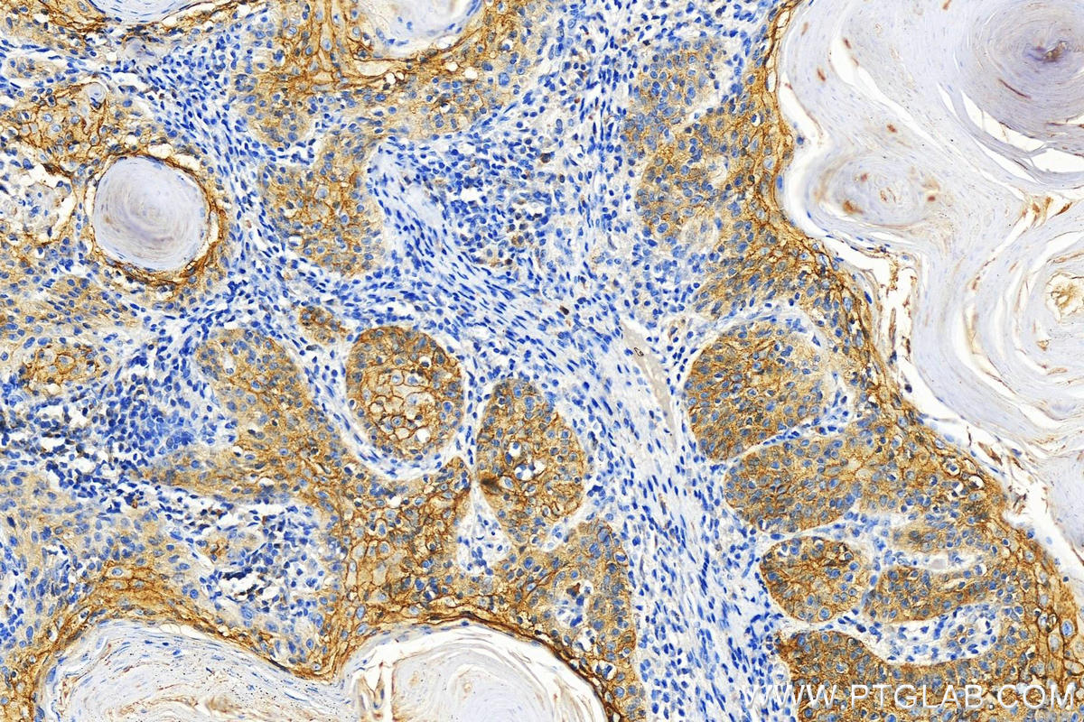 Immunohistochemistry (IHC) staining of human skin cancer tissue using TACSTD2/TROP2 Polyclonal antibody (29856-1-AP)