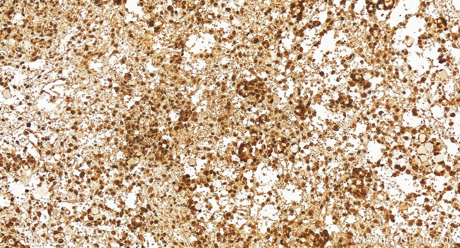 Immunohistochemistry (IHC) staining of human ovary cancer tissue using TADA2B Polyclonal antibody (17367-1-AP)