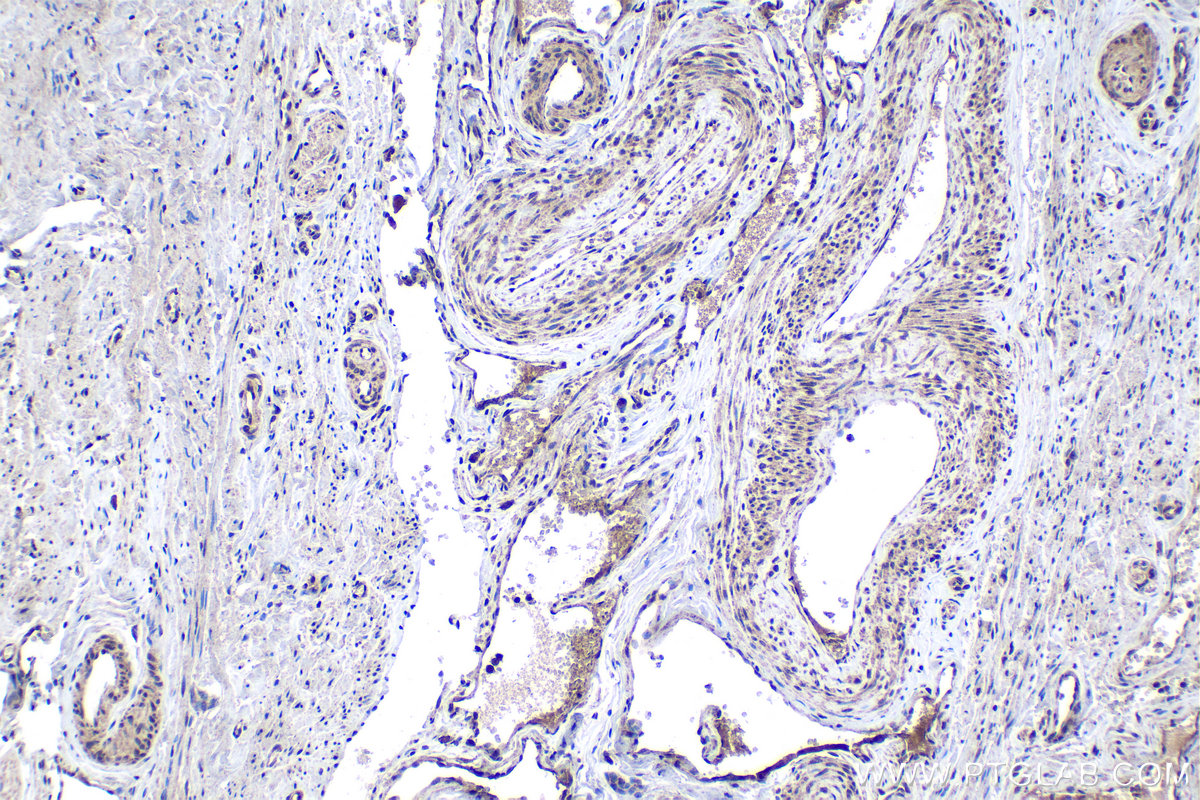 Immunohistochemistry (IHC) staining of human cervical cancer tissue using TAF15 Polyclonal antibody (24235-1-AP)