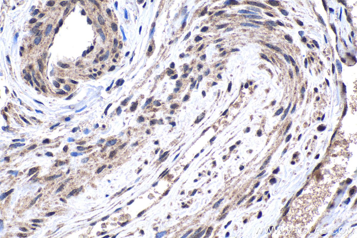 Immunohistochemistry (IHC) staining of human cervical cancer tissue using TAF15 Polyclonal antibody (24235-1-AP)