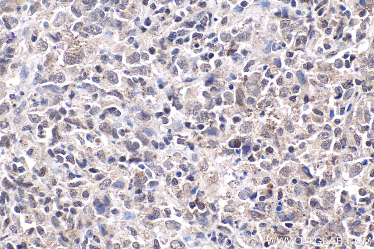 Immunohistochemistry (IHC) staining of human malignant melanoma tissue using TAF15 Polyclonal antibody (24235-1-AP)