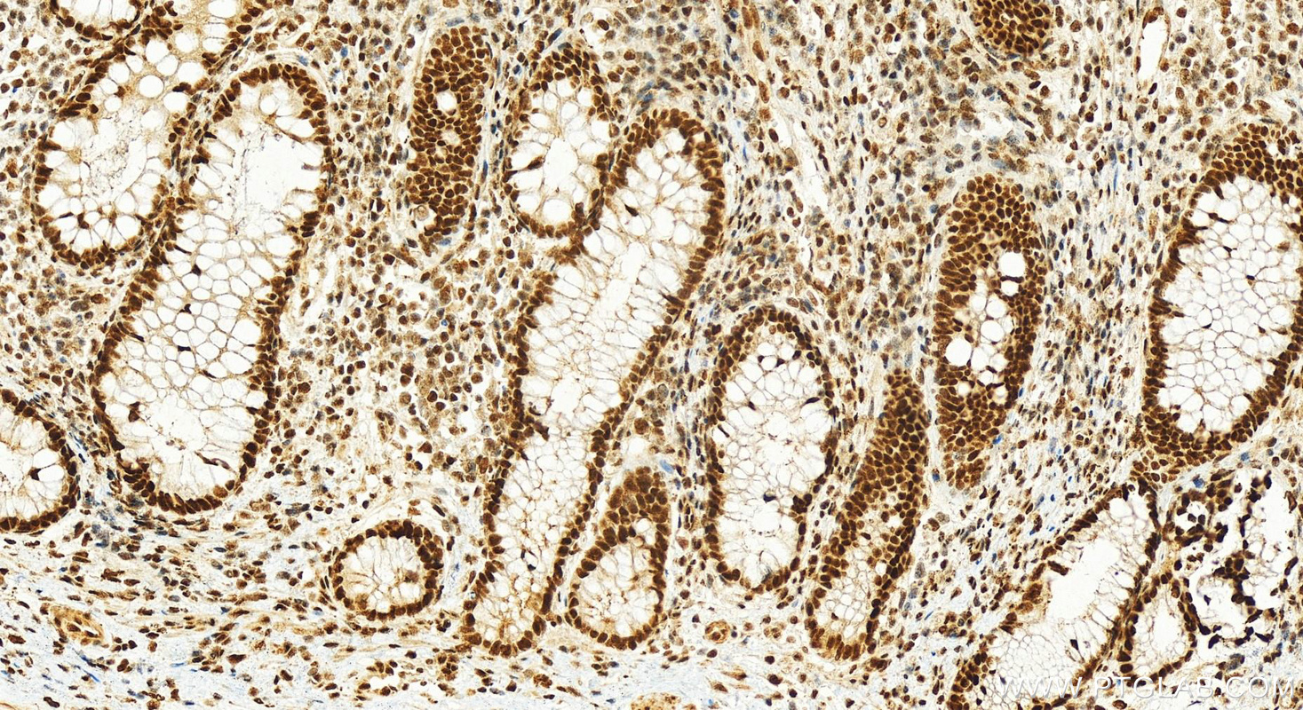 Immunohistochemistry (IHC) staining of human colon cancer tissue using TAF15 Polyclonal antibody (25521-1-AP)