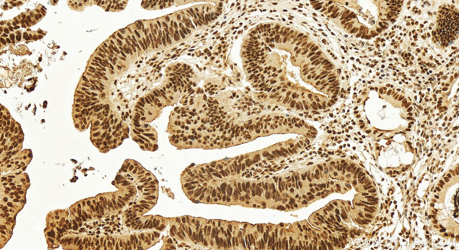 Immunohistochemistry (IHC) staining of human colon cancer tissue using TAF15 Polyclonal antibody (25521-1-AP)