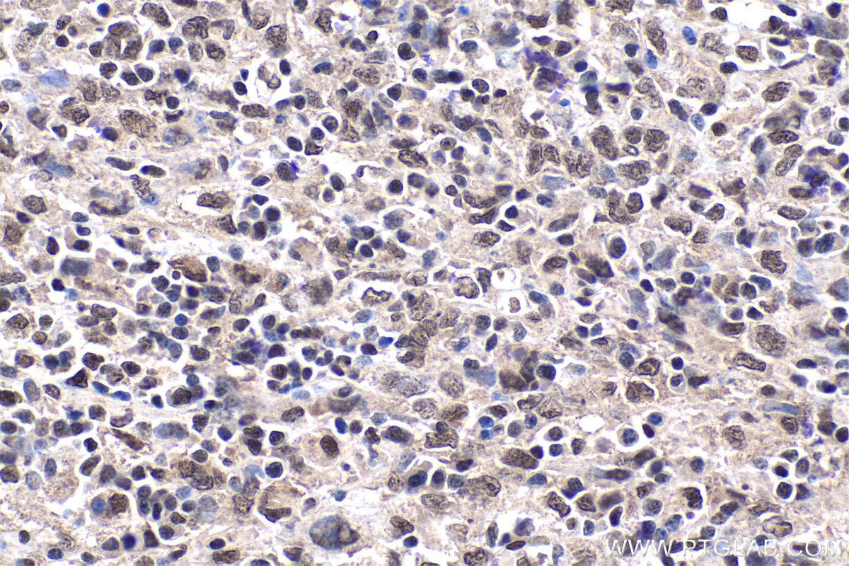 Immunohistochemistry (IHC) staining of human malignant melanoma tissue using TAF15 Polyclonal antibody (25521-1-AP)