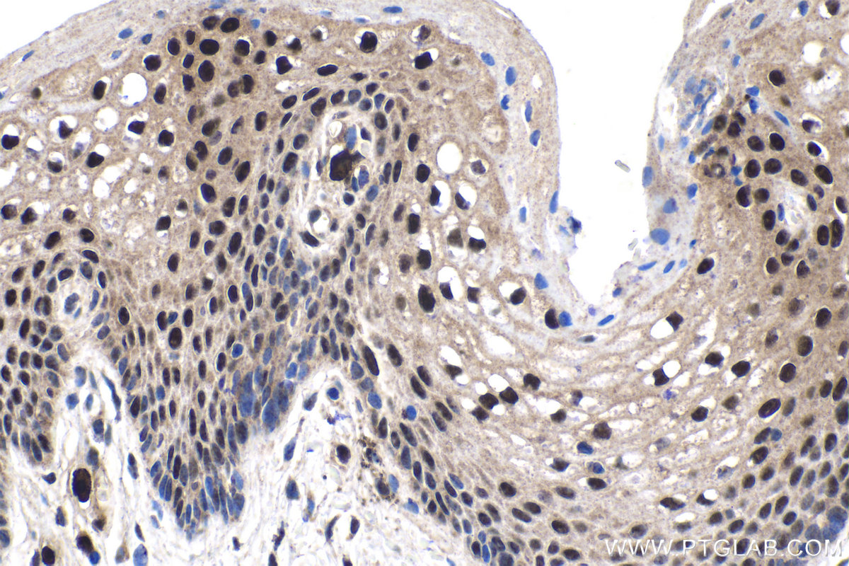 Immunohistochemistry (IHC) staining of human cervical cancer tissue using TAF15 Polyclonal antibody (25521-1-AP)