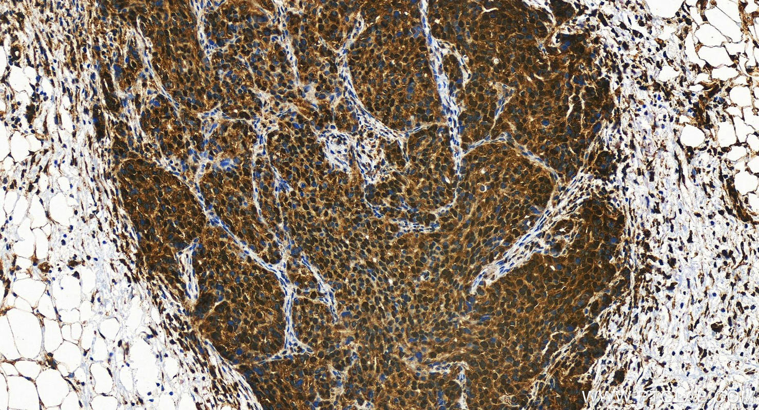 Immunohistochemistry (IHC) staining of human ovary cancer tissue using TAF5L Polyclonal antibody (19274-1-AP)