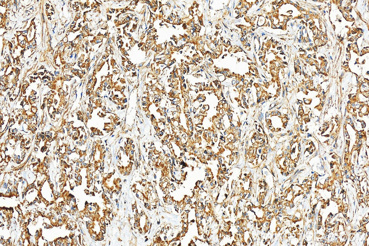 Immunohistochemistry (IHC) staining of human intrahepatic cholangiocarcinoma tissue using Transgelin 2 Polyclonal antibody (10234-2-AP)