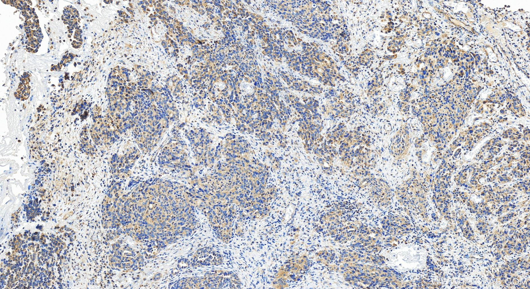 Immunohistochemistry (IHC) staining of human ovary cancer tissue using Transgelin 2 Polyclonal antibody (10234-2-AP)