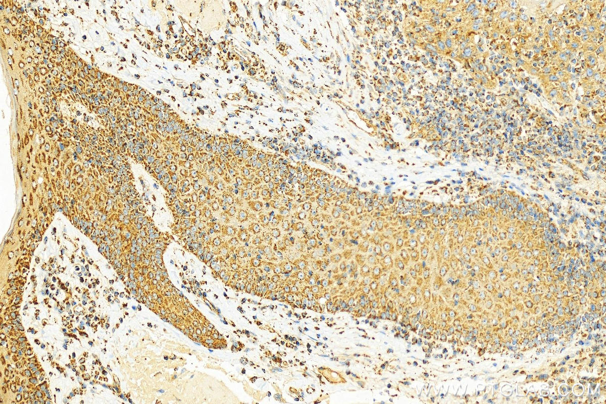 Immunohistochemistry (IHC) staining of human skin cancer tissue using Transgelin 2 Polyclonal antibody (10234-2-AP)