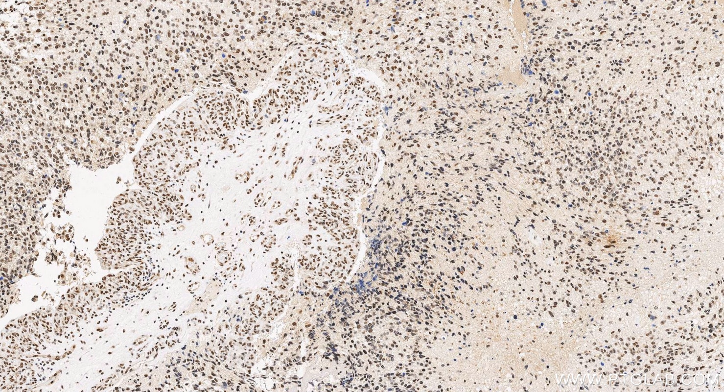 Immunohistochemistry (IHC) staining of human gliomas tissue using TDP-43 (human specific) Monoclonal antibody (60019-2-Ig)