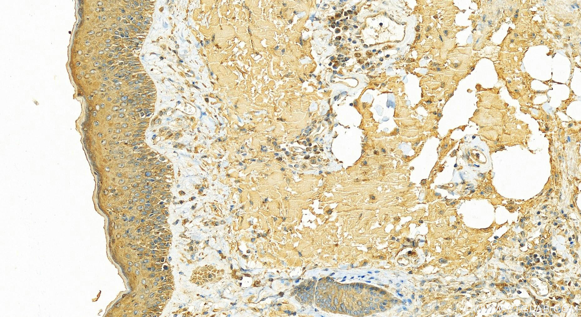 Immunohistochemistry (IHC) staining of human skin cancer tissue using TAX1BP1 Polyclonal antibody (14424-1-AP)