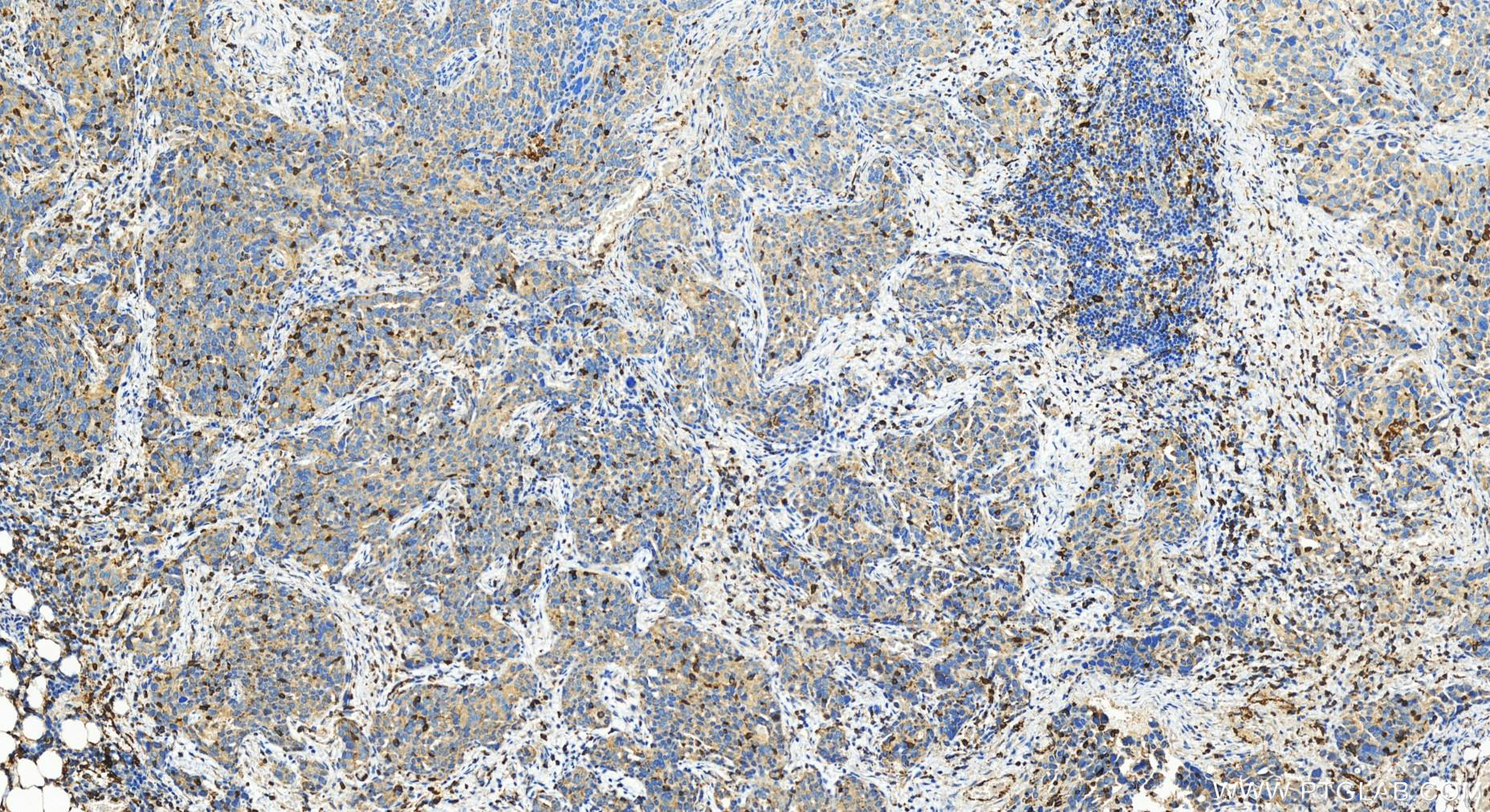 Immunohistochemistry (IHC) staining of human ovary cancer tissue using TBXAS1 Polyclonal antibody (30215-1-AP)