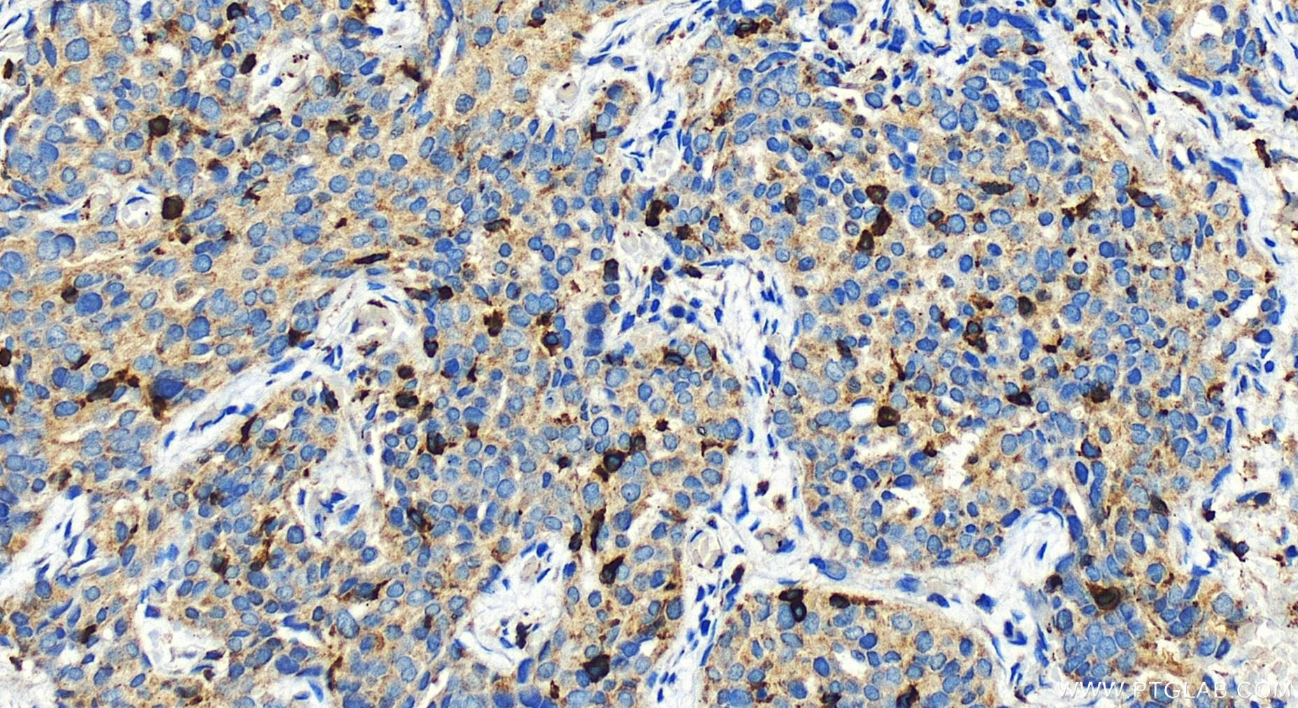 Immunohistochemistry (IHC) staining of human ovary cancer tissue using TBXAS1 Polyclonal antibody (30215-1-AP)