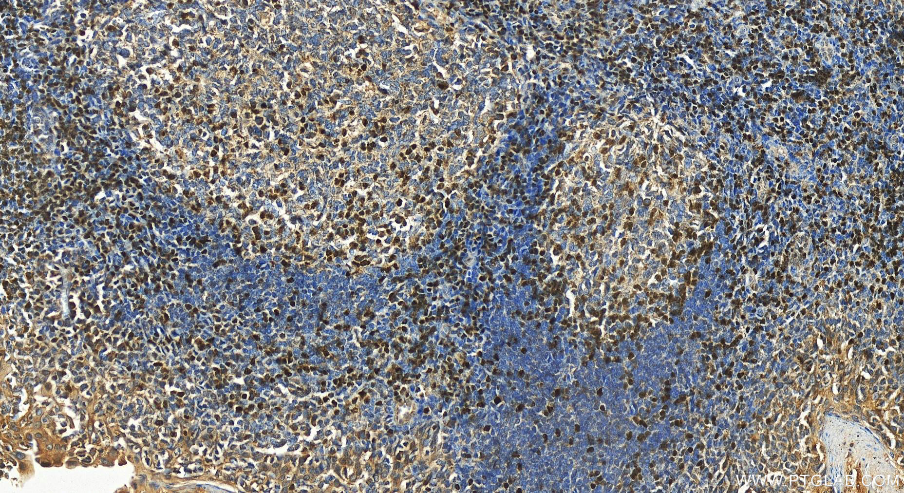 Immunohistochemistry (IHC) staining of human tonsillitis tissue using TCF1/TCF7 Polyclonal antibody (14464-1-AP)