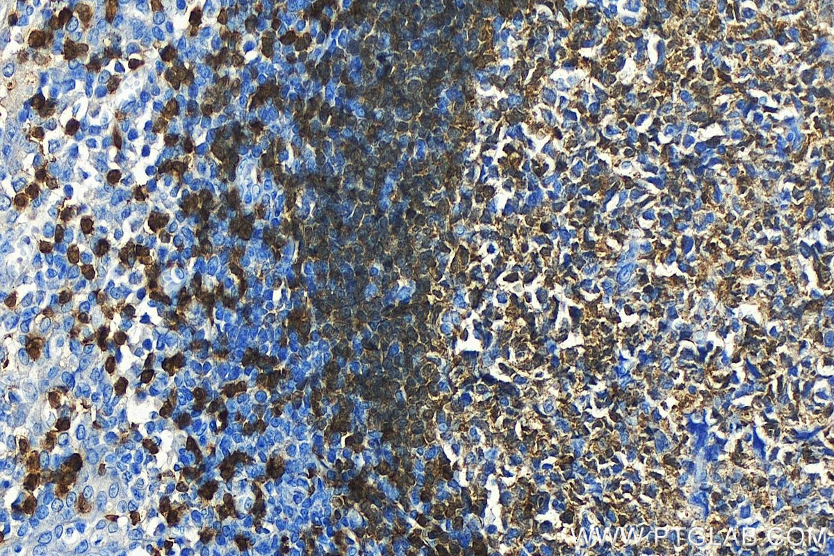 Immunohistochemistry (IHC) staining of human tonsillitis tissue using TCL1A Polyclonal antibody (10475-1-AP)