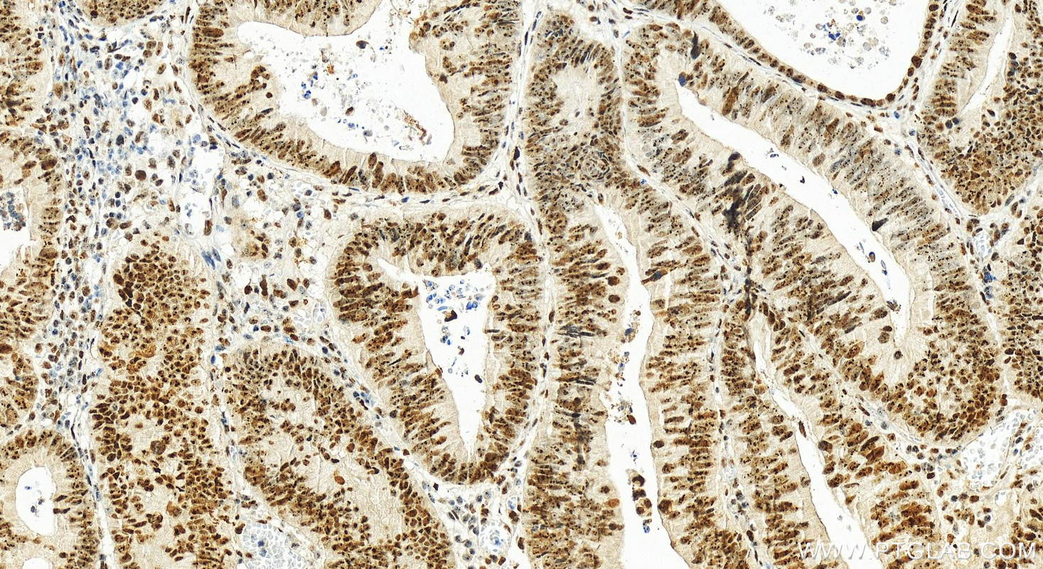 Immunohistochemistry (IHC) staining of human colon cancer tissue using TCOF1 Polyclonal antibody (11003-1-AP)