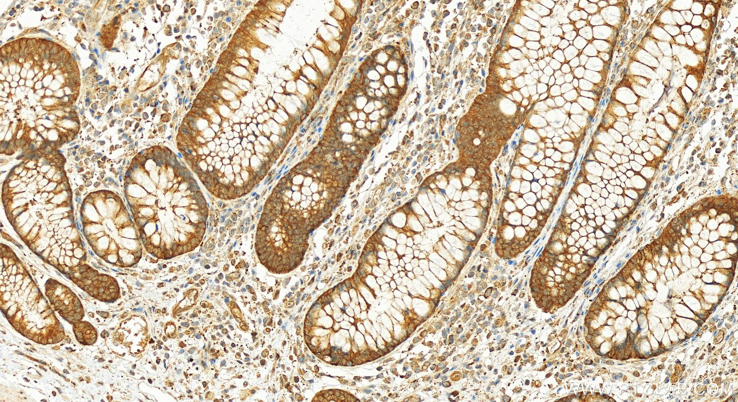 Immunohistochemistry (IHC) staining of human colon cancer tissue using TCP1 Polyclonal antibody (10320-1-AP)