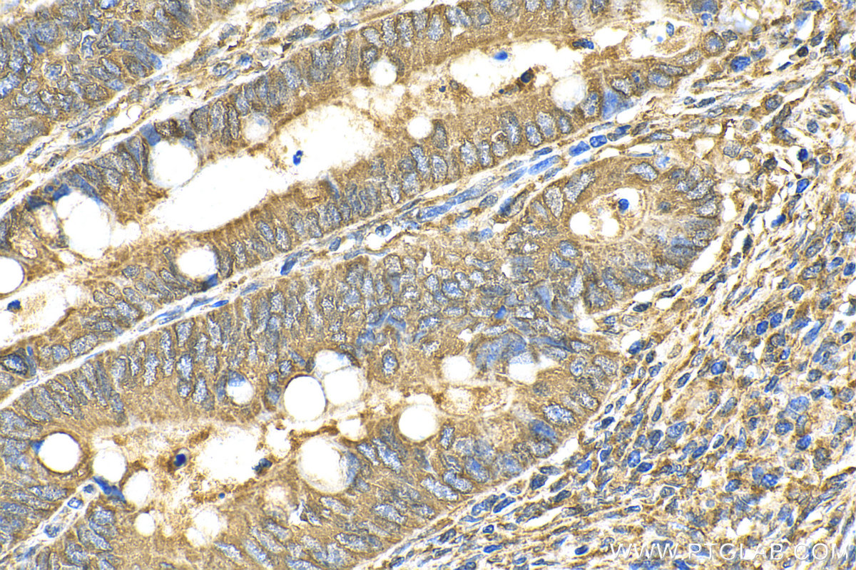 Immunohistochemistry (IHC) staining of human colon cancer tissue using TCTN2 Recombinant antibody (82120-1-RR)