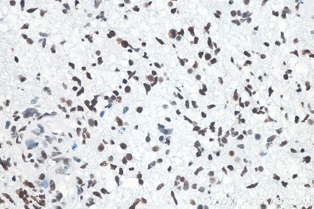 Immunohistochemistry (IHC) staining of human gliomas tissue using TDP-43 (N-terminal) Recombinant monoclonal antibod (80001-1-RR)