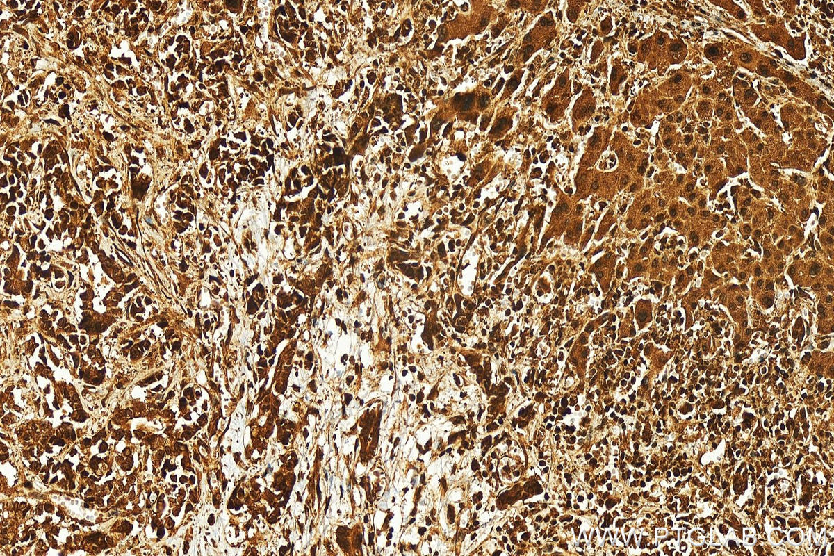 Immunohistochemistry (IHC) staining of human intrahepatic cholangiocarcinoma tissue using TDP1 Polyclonal antibody (10641-1-AP)