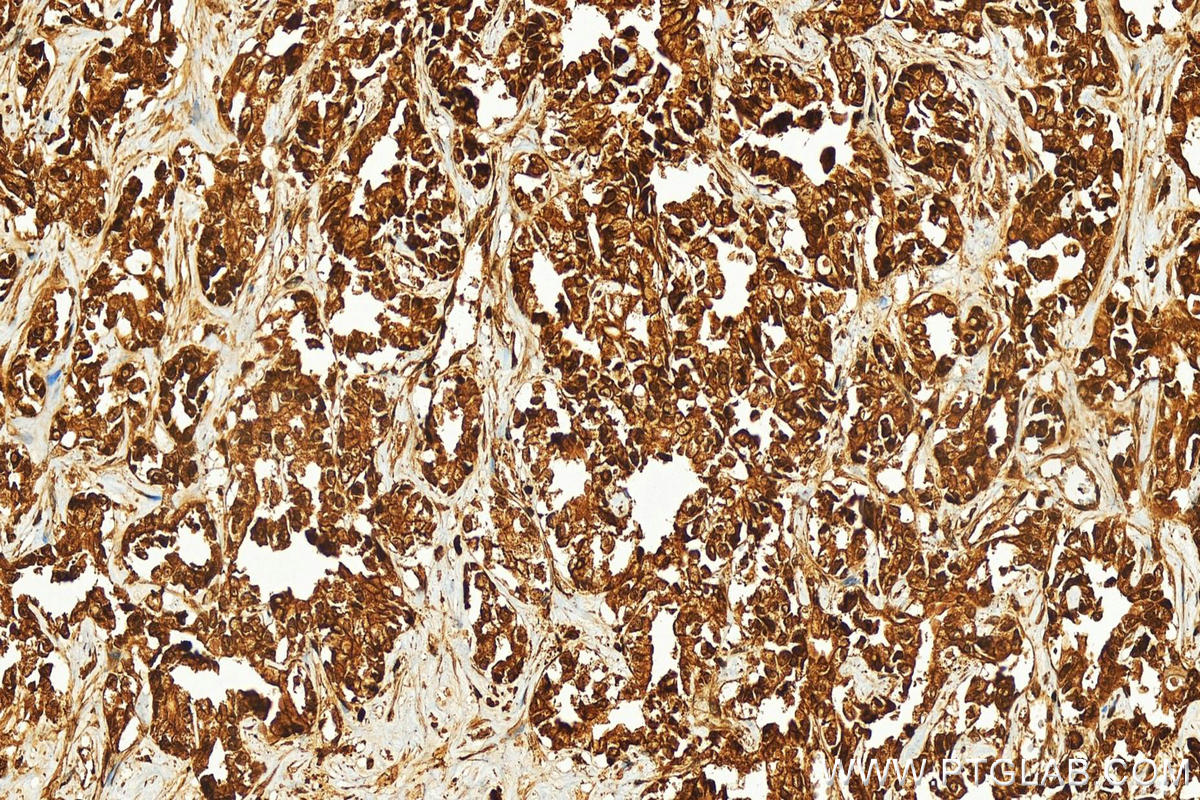 Immunohistochemistry (IHC) staining of human intrahepatic cholangiocarcinoma tissue using TDP1 Polyclonal antibody (10641-1-AP)