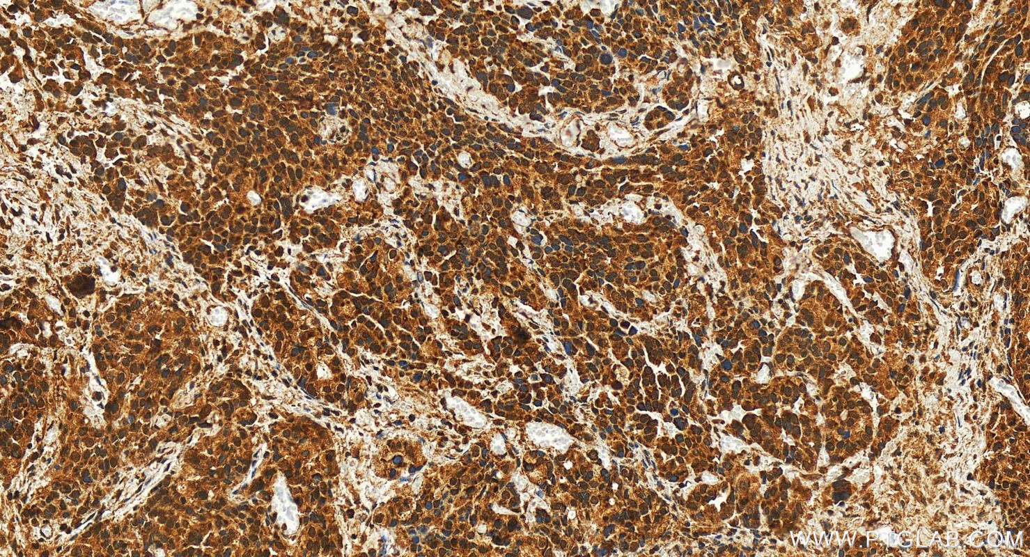 Immunohistochemistry (IHC) staining of human ovary cancer tissue using TDP1 Polyclonal antibody (10641-1-AP)