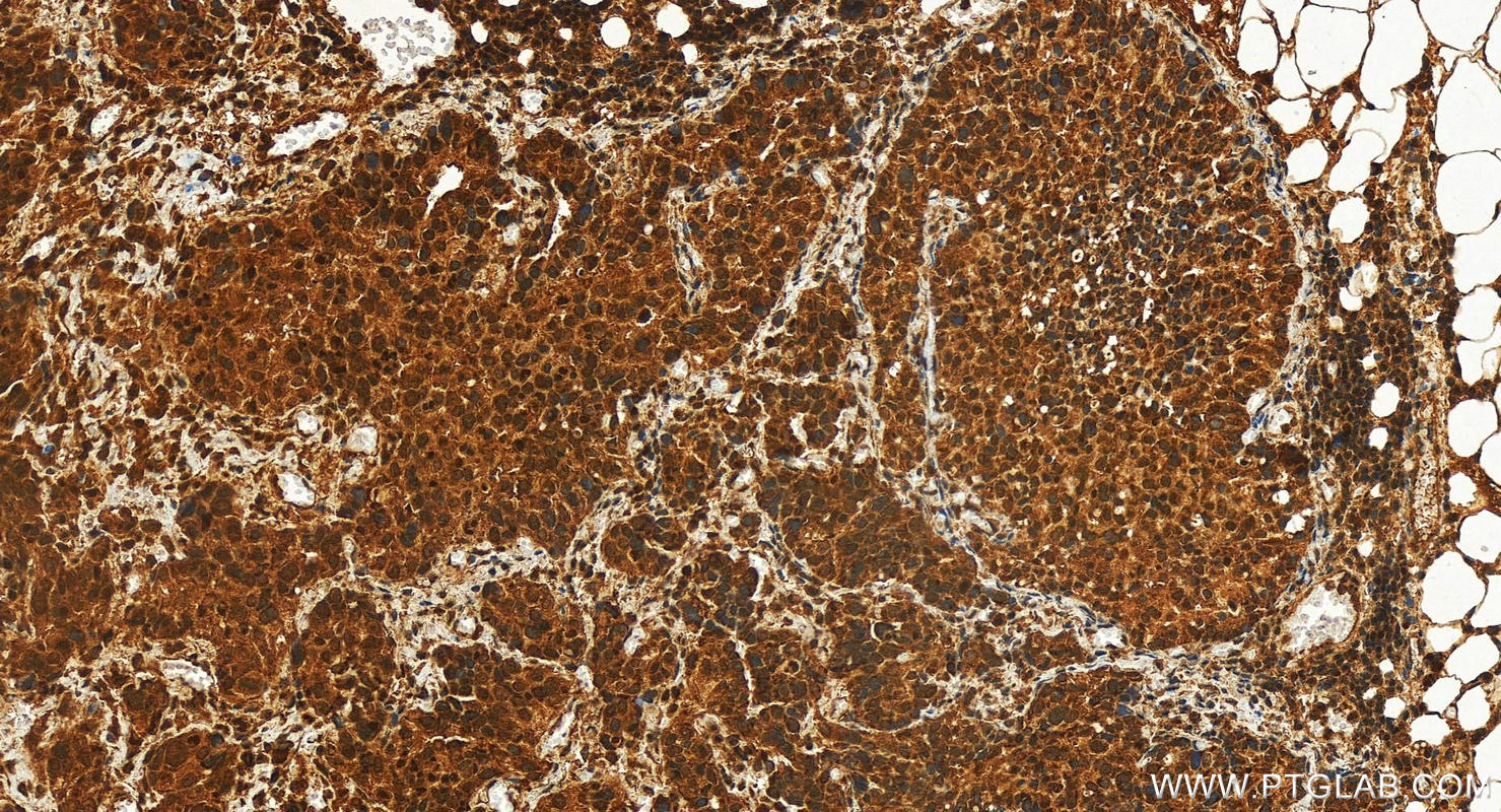 Immunohistochemistry (IHC) staining of human ovary cancer tissue using TDP1 Polyclonal antibody (10641-1-AP)