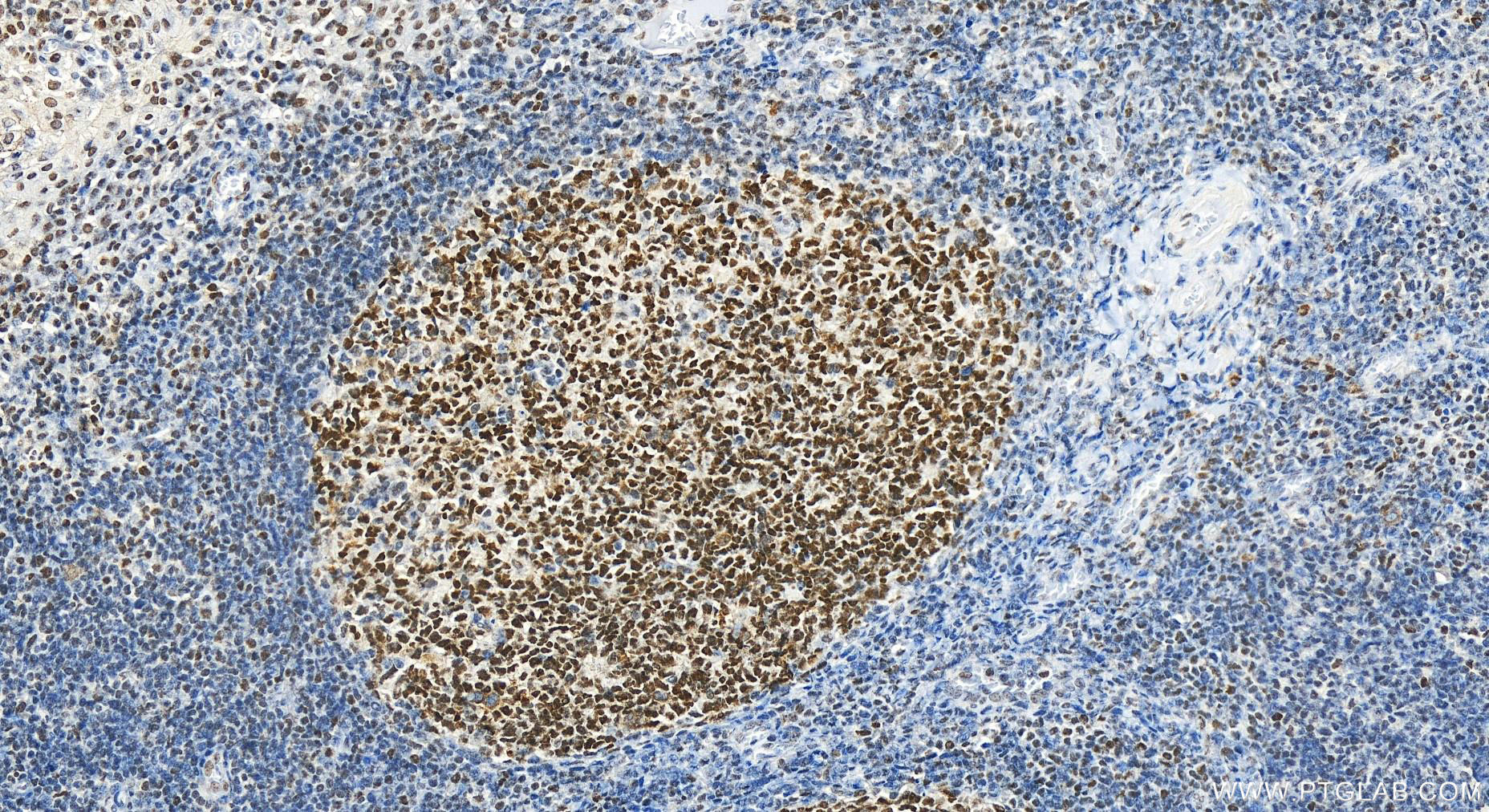 Immunohistochemistry (IHC) staining of human tonsillitis tissue using TERF2IP Polyclonal antibody (14595-1-AP)